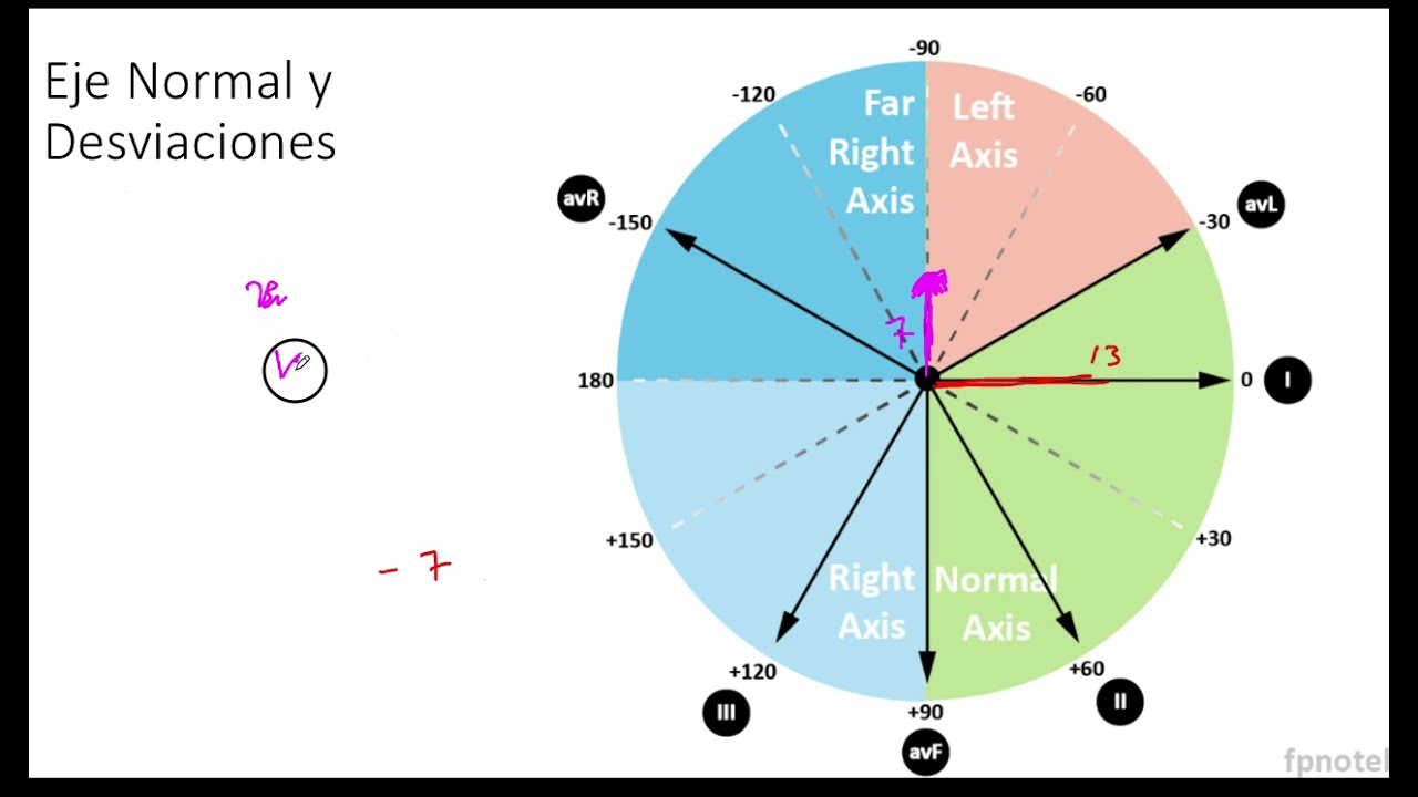 Determinación Exacta del Eje cuando está Desviado la Izquierda EKG