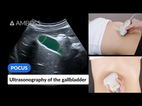 Point of Care Ultrasound of the Gallbladder - AMBOSS Video