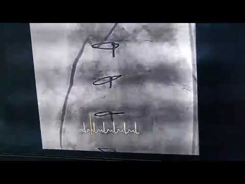 Post Bypaas: Saphenous Vein Graft Angioplasty and Stent Tips : Prof Dr Vivek Gupta 14.2.2023 Valent