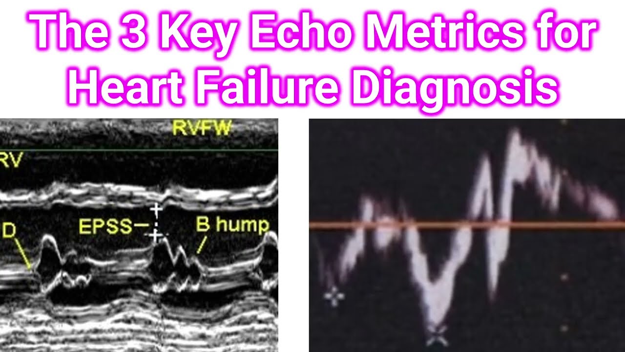 The 3 Key Echo Metrics for Heart Failure Diagnosis