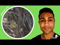 1 479 Auricular Hypertrichosis Excessive Hairy Ears Ear Wax Removal