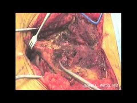 Chordoma Of The Sacrum Cryoremoval