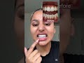 Hismile V34 Colour Corrector Beauty Teethcleaning Shortsviral