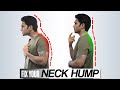 How To Fix Neck Hump Causes Problems Simple Solutions Explained