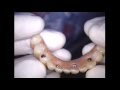 DR. GERARD CUOMO - Dental Implants - screw ...