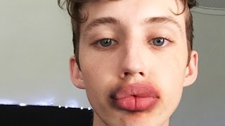 KYLIE JENNER LIP CHALLENGE GONE WRONG