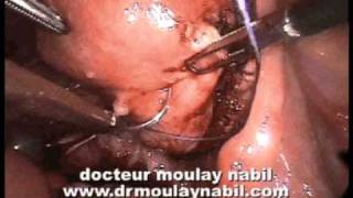 preview picture of video 'laparoscopic treatment of cystic uterine myoma'