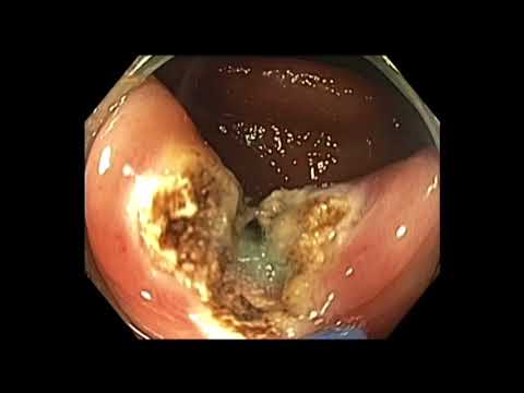 Colonoscopy: Removal of a Tethered Cecal Polyp form Prior Incomplete Resection