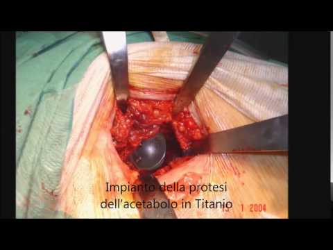 Indicazioni per artroscopia del ginocchio Freddo sulla schiena