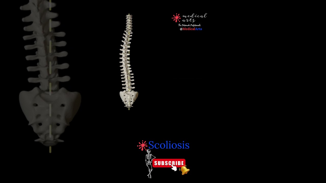 Scoliosis Animation - Different types of scoliosis