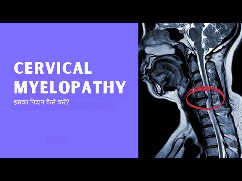 What is cervical myelopathy? How to diagnose it ? | Dr. Ajay Kothari| 