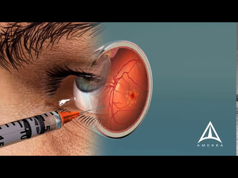 Macular Degeneration - vision disease - 3D animation