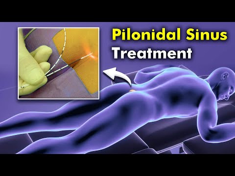 How Sinus Laser Treatment Works – Step-by-Step Guide with Animation