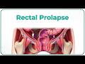 Rectal Prolapse Introduction Clinical Features Diagnosis Management Surgery