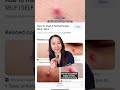 How to Treat Different Types of Acne #shorts