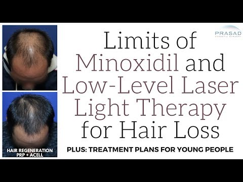 Limits of Low-Level Laser Therapy and Minoxidil for Hair Loss, and a Treatment Plan for Young People