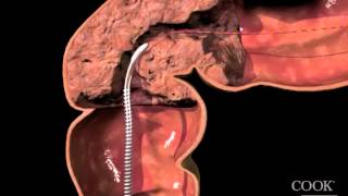 Evolution® Colonic Controlled-Release Stent - Uncovered Endoscopic Animation