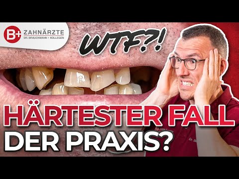 Krasser Patientenfall 🤯 Zahnarztangst überwunden! Kronen & Brücken für Oberkiefer und Unterkiefer