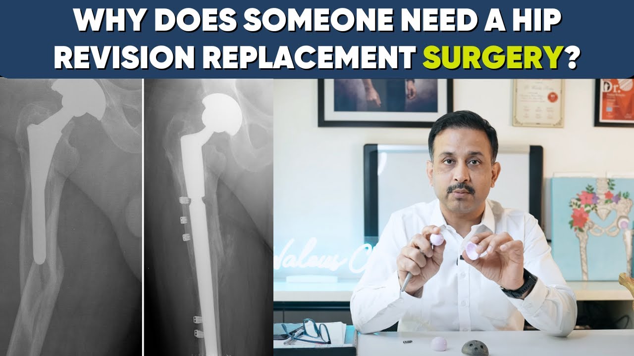 Reason for Revision Hip Replacement: Every thing you need to know about it! #thr #revisionsurgery