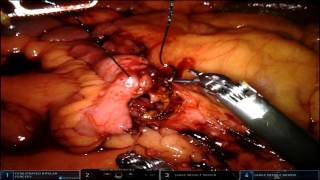 Download Lagu Intracorporeal Anastomosis with Traction Suture Thumbnail