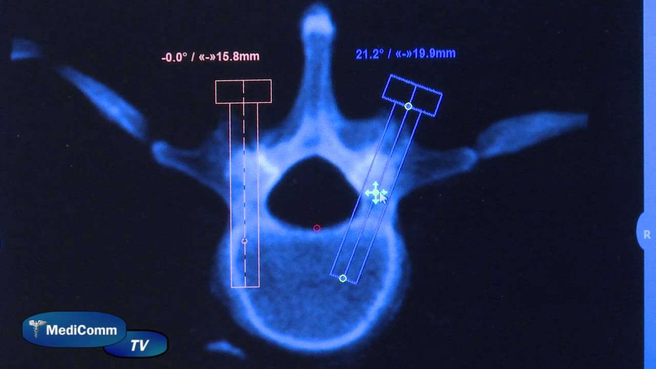 MediCommTV Mazor Robotic