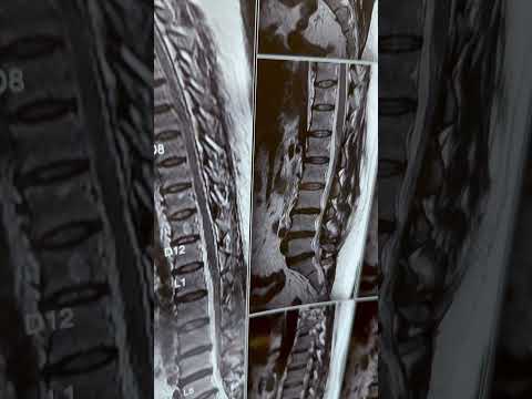 Lumbar spine slipdisc - Dr. Ajay Kothari