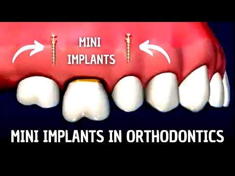 Mini Implants in Orthodontics