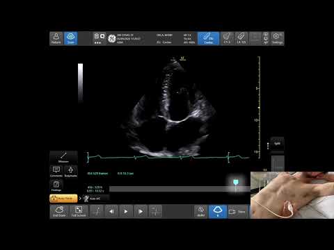 Training video for the donor heart transthoracic echo assessment