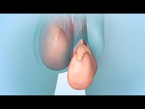 Procedimientos de recuperación de espermatozoides para la concepción