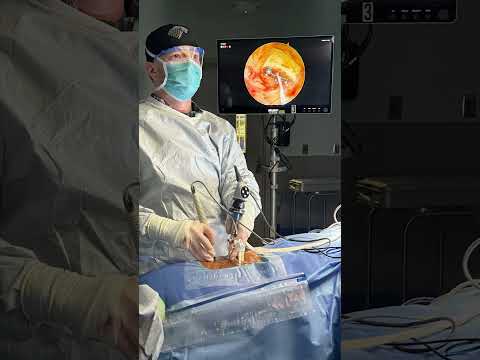 Severe Leg Pain Relief: Endoscopic Spine Surgery Success