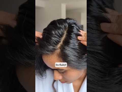 Dry Scalp Problems | Dry Flaky Itchy Scalp | Dry Frizzy Curl Hair | Curly Hair Problems | Wavy Hair