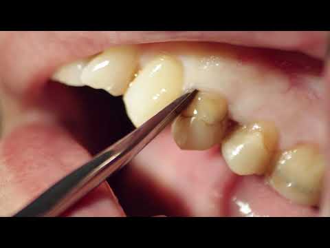 Cum folosesti instrumentarul SLIMLIFT S5 LM Dental