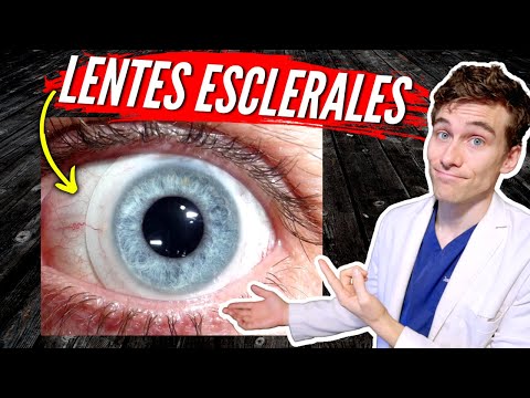 Scleral Lenses for Keratoconus: 7 Things You Should Know