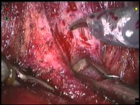 Robotic Assisted Laparoscopic Radical Prostatectomy (RALRP)