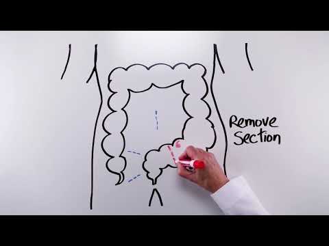Sigmoidectomy Short Version