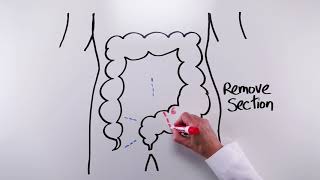 Sigmoidectomy (Short version)