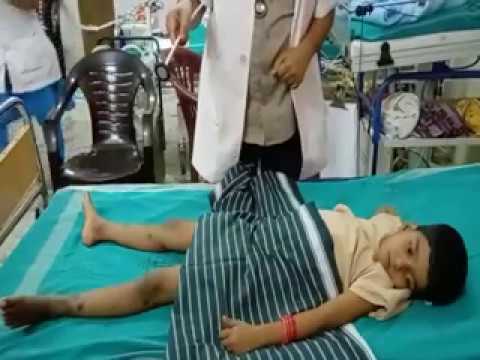 An Interesting Case Of Weakness In A Girl, Atypical Presentation Of A Common Case