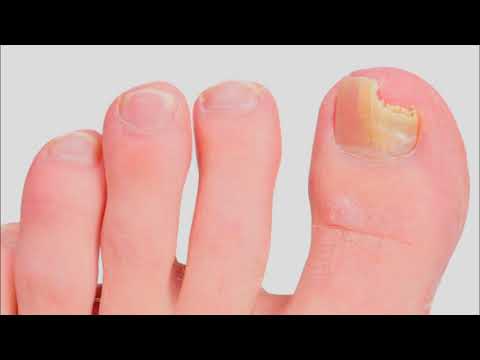Kuko halamang-singaw sa malaking bata toe paggamot Kuko halamang-singaw sa kamay na may mga larawan