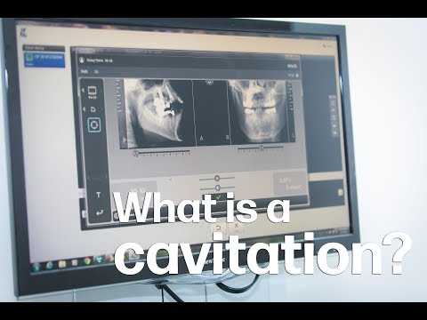 YouTube video about: How do I know if I have dental cavitation?