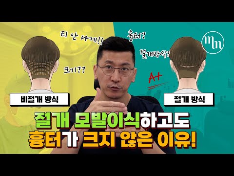 절개 모발이식 했는데 흉터가 크지 않은 이유! l 김경복원장 l 모먼트의원(MOMENT)