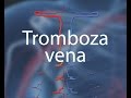 Ultrasonografija - Tromboza vena 