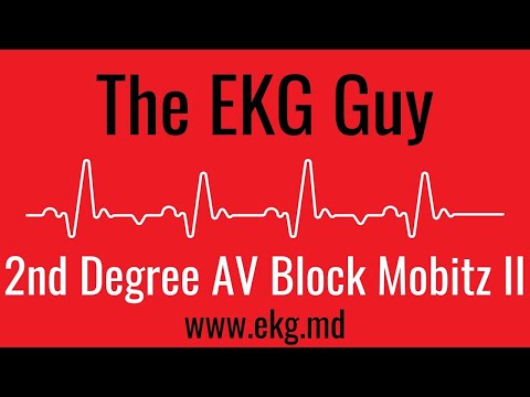 Second Degree AV Block Mobitz II EKG l The EKG Guy - www.ekg.md