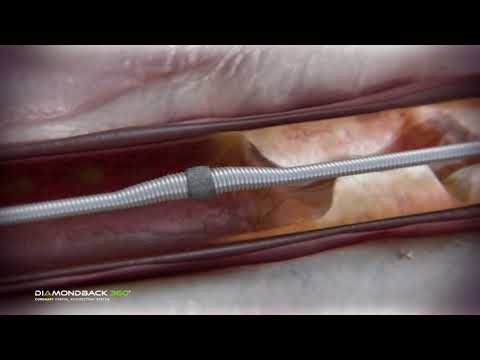 Coronary Orbital Atherectomy