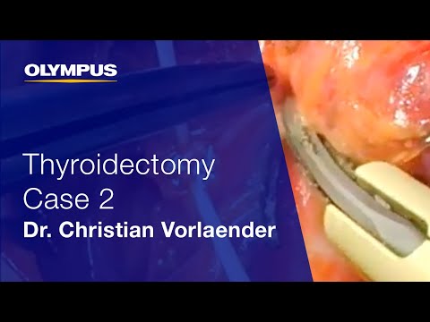 Total Thyroidectomy | THUNDERBEAT |  Dr. Christian Vorlaender | Case 2