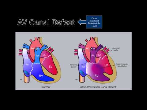 Fetal Echocardiography: AV Canal Defect