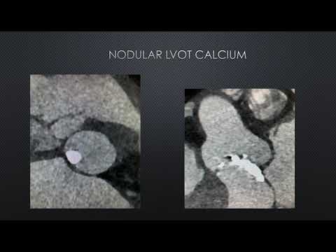 How I managed a difficult Lotus case- Santiago Garcia, MD