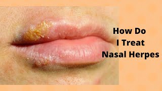 How Do I Treat Nasal Herpes
