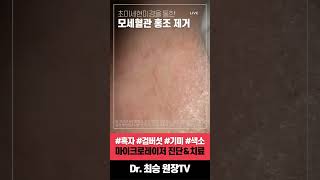 Surgical Microscope in Facial Redness Treatment: Rosacea and Visible Vessels