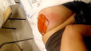 Giant Back Abscess Gets Drained