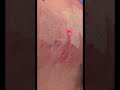 Acne Scar Laser #shorts #shortvideo